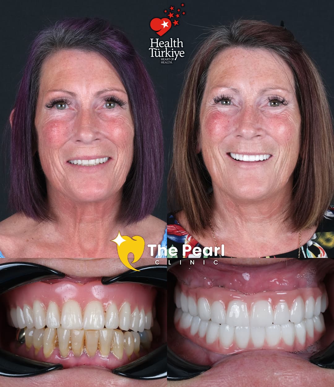 All-on-6 Transformation 3